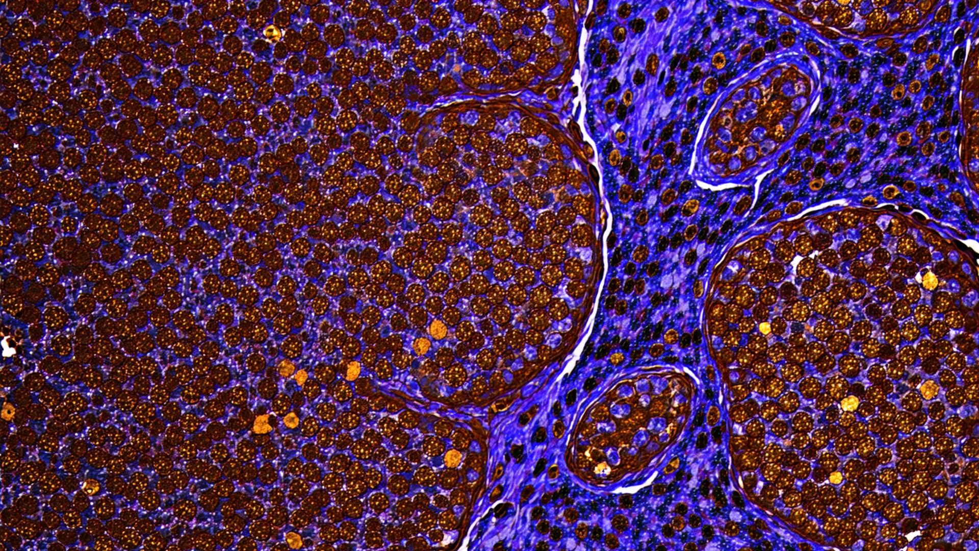 Abstract artistic rendering of immunohistochemistry-stained tissue with rich brown DAB-positive cells on blue-purple hematoxylin background