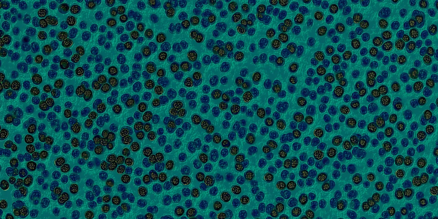 Artistic rendering of Ki-67 IHC staining showing nuclear positivity proliferation index pattern